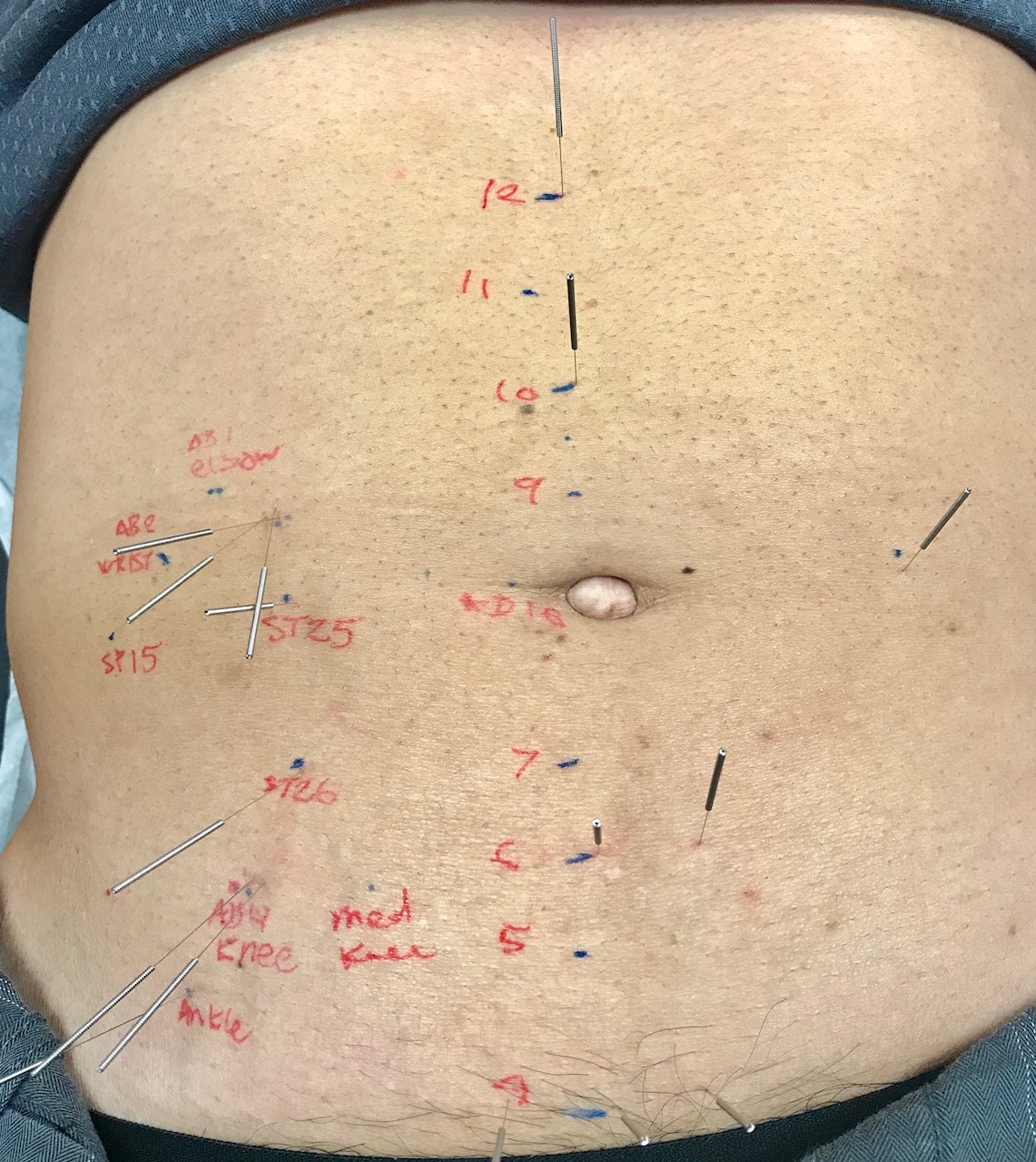 Abdominal Acupuncture | Tripoint Holistic Therapy